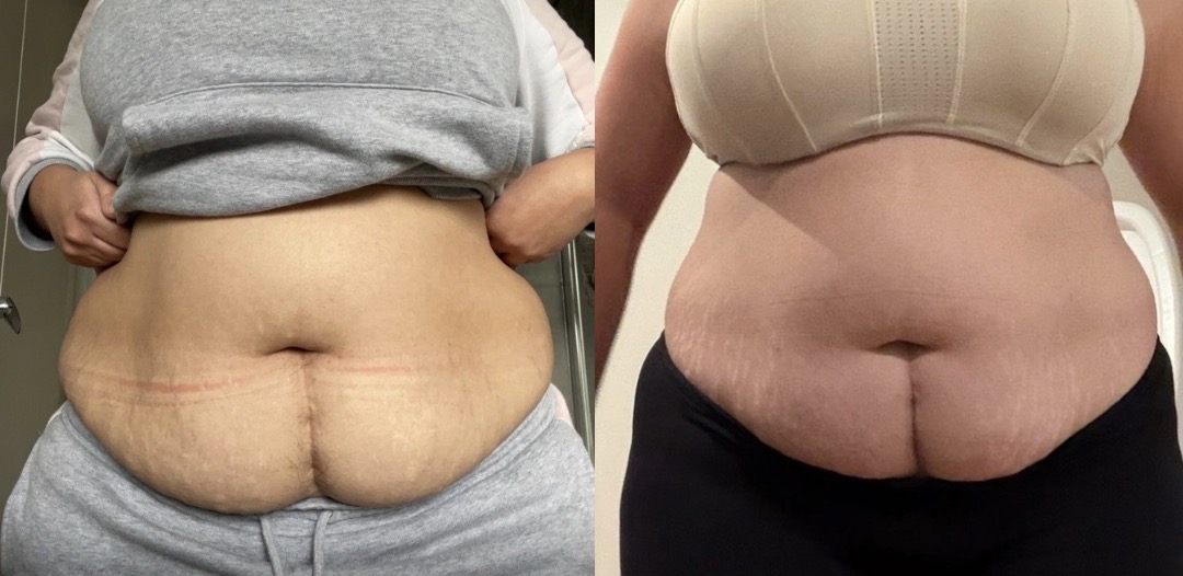 Transformación real · abdomen desinflamado